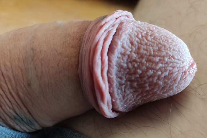 Сморщенная залупа