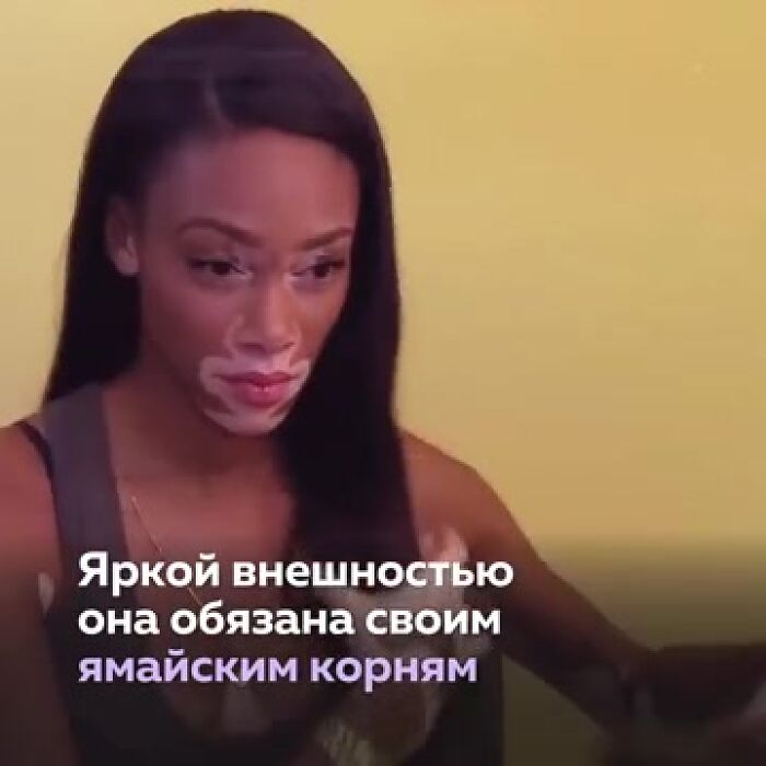 Vitiligo Витилиго