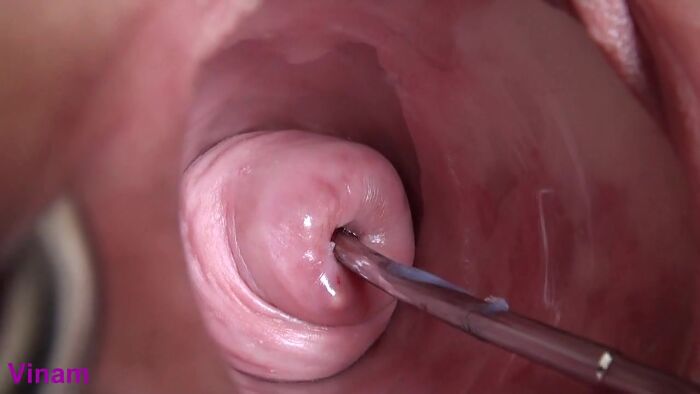 Мастурбация шейки матки