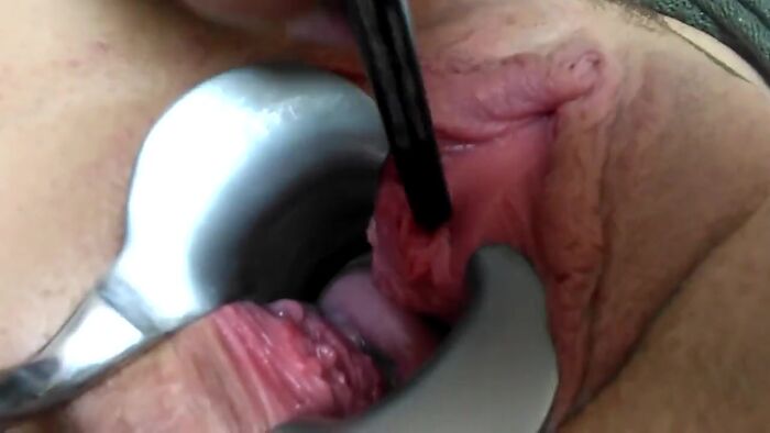 растягивание уретры