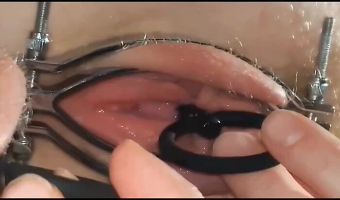 Мне расширяют мою шейку матки